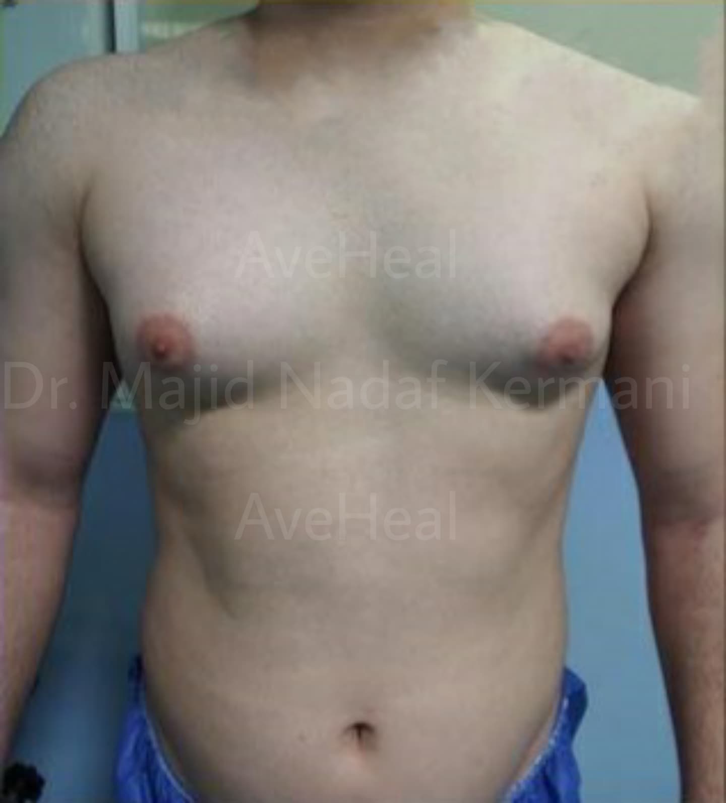 before-gynecomastia-dr-majid-nadaf-kermani