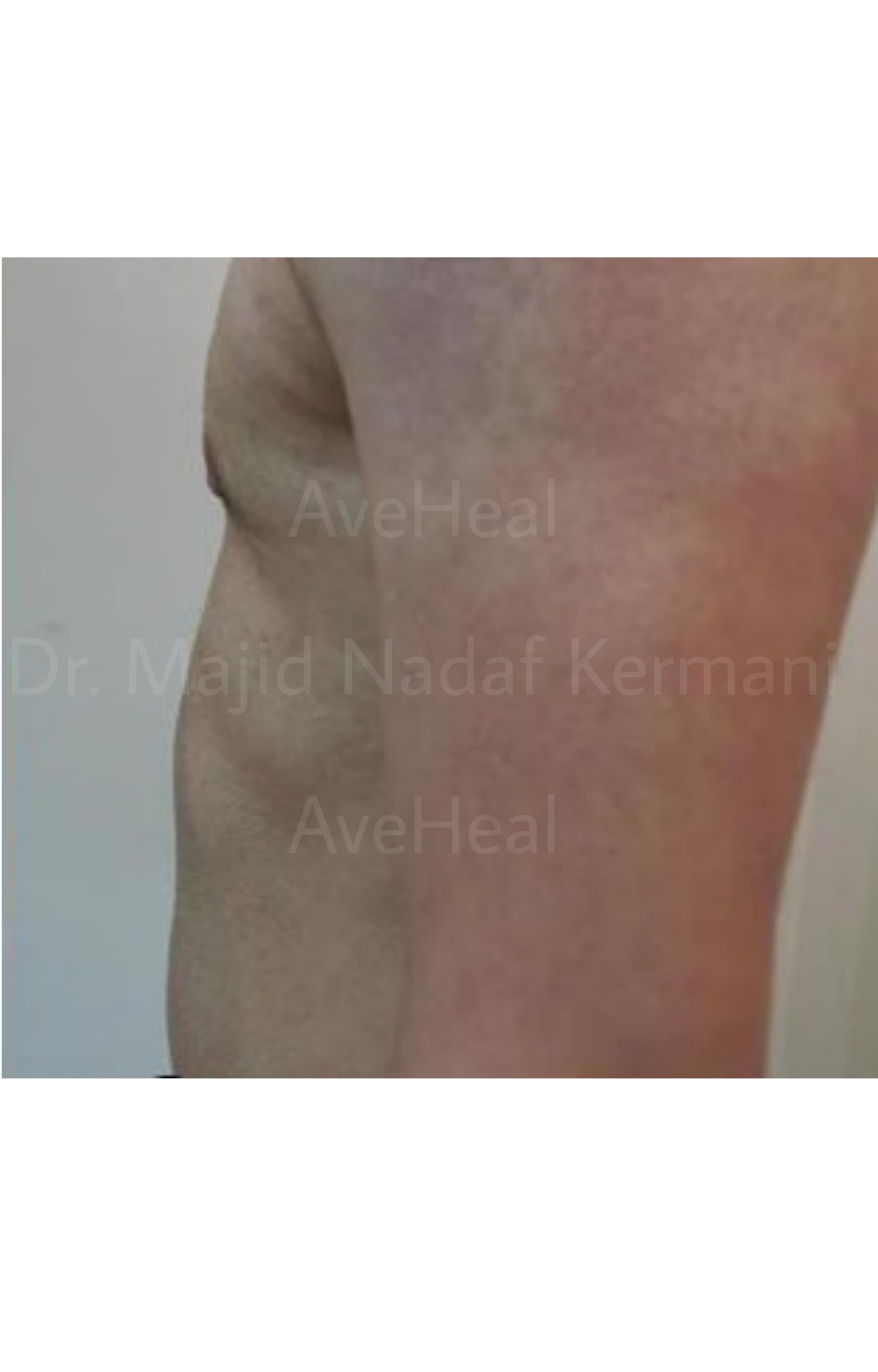 after-gynacomastia-dr-majid-nadaf-kermani