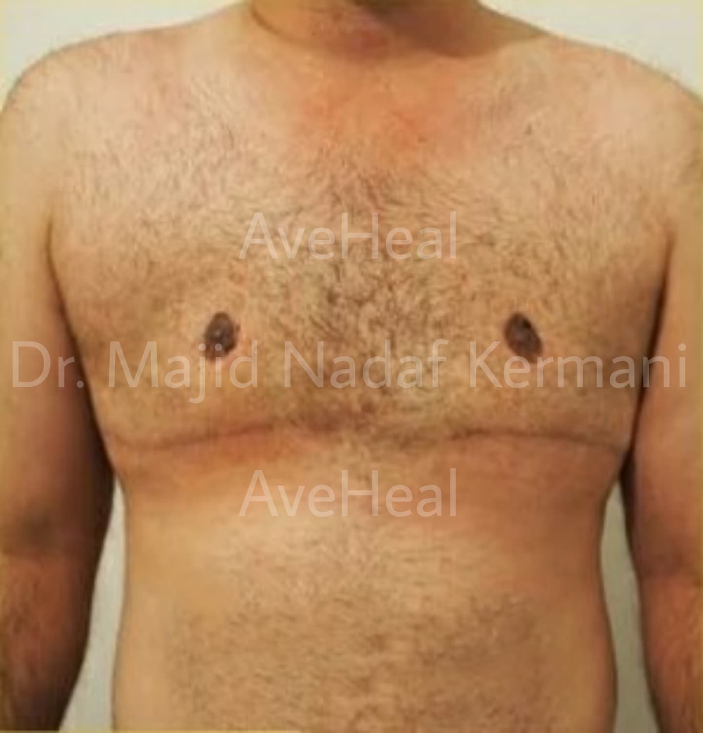 after-gynacomastia-dr-majid-nadaf-kermani