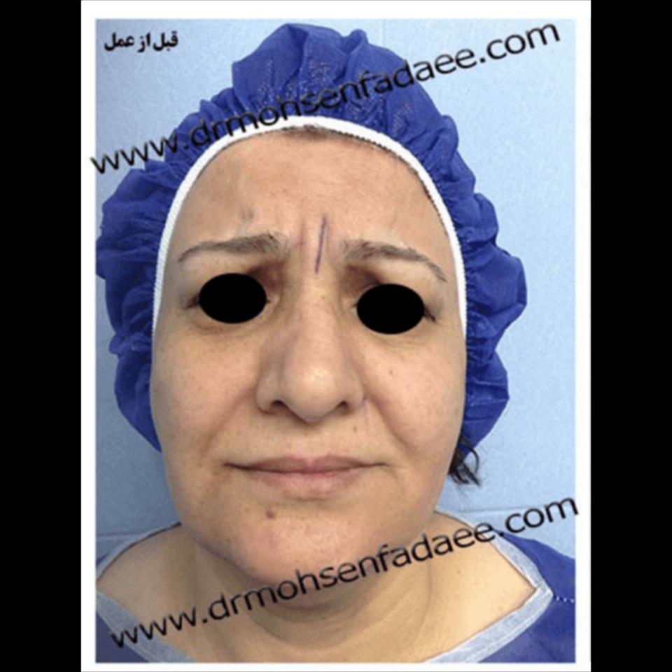 before-face-lift-dr-mohsen-fadaei-iran