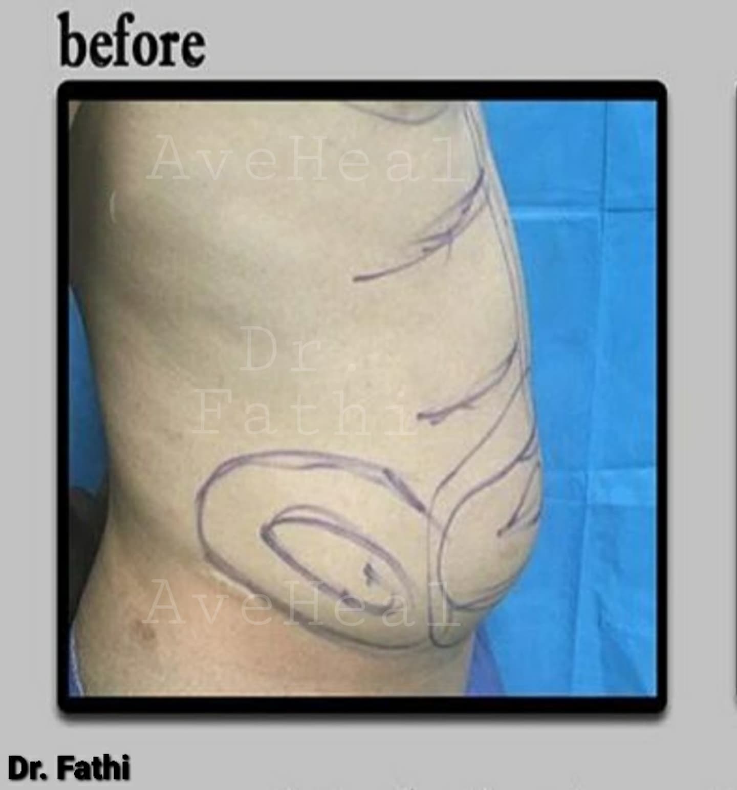 before-liposuction-dr-hamidreza-fathi