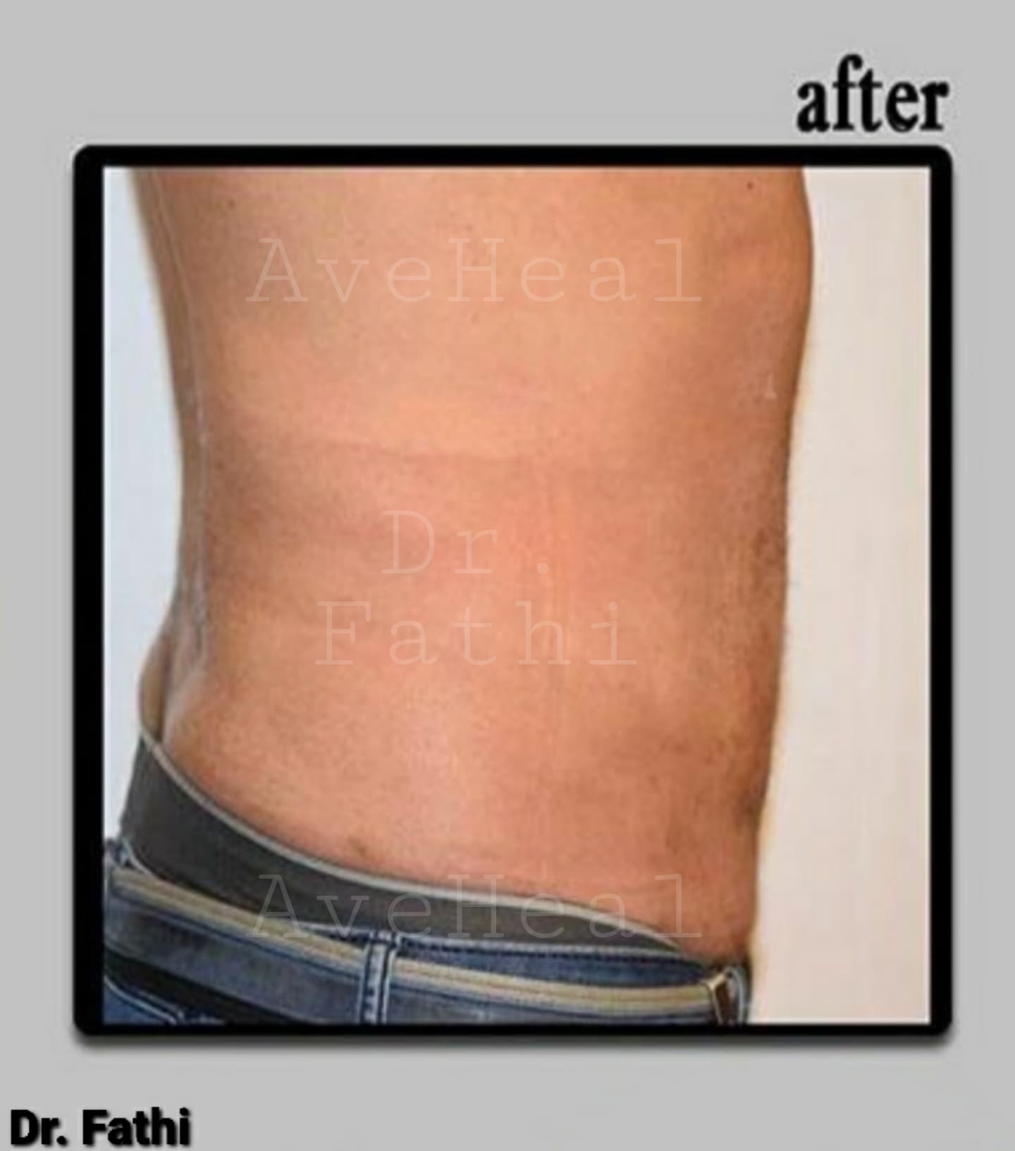 after-liposuction-dr-hamidreza-fathi