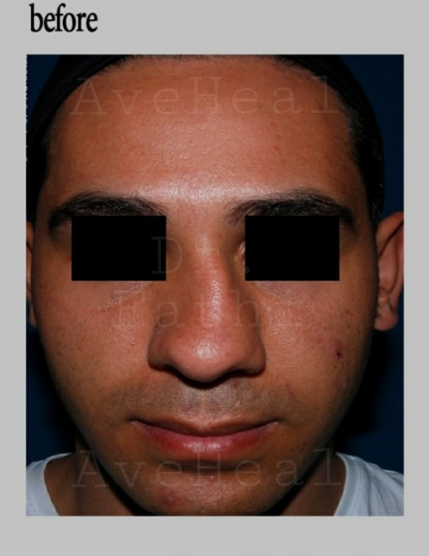 before-rhinoplasty-dr-hamidreza-fathi