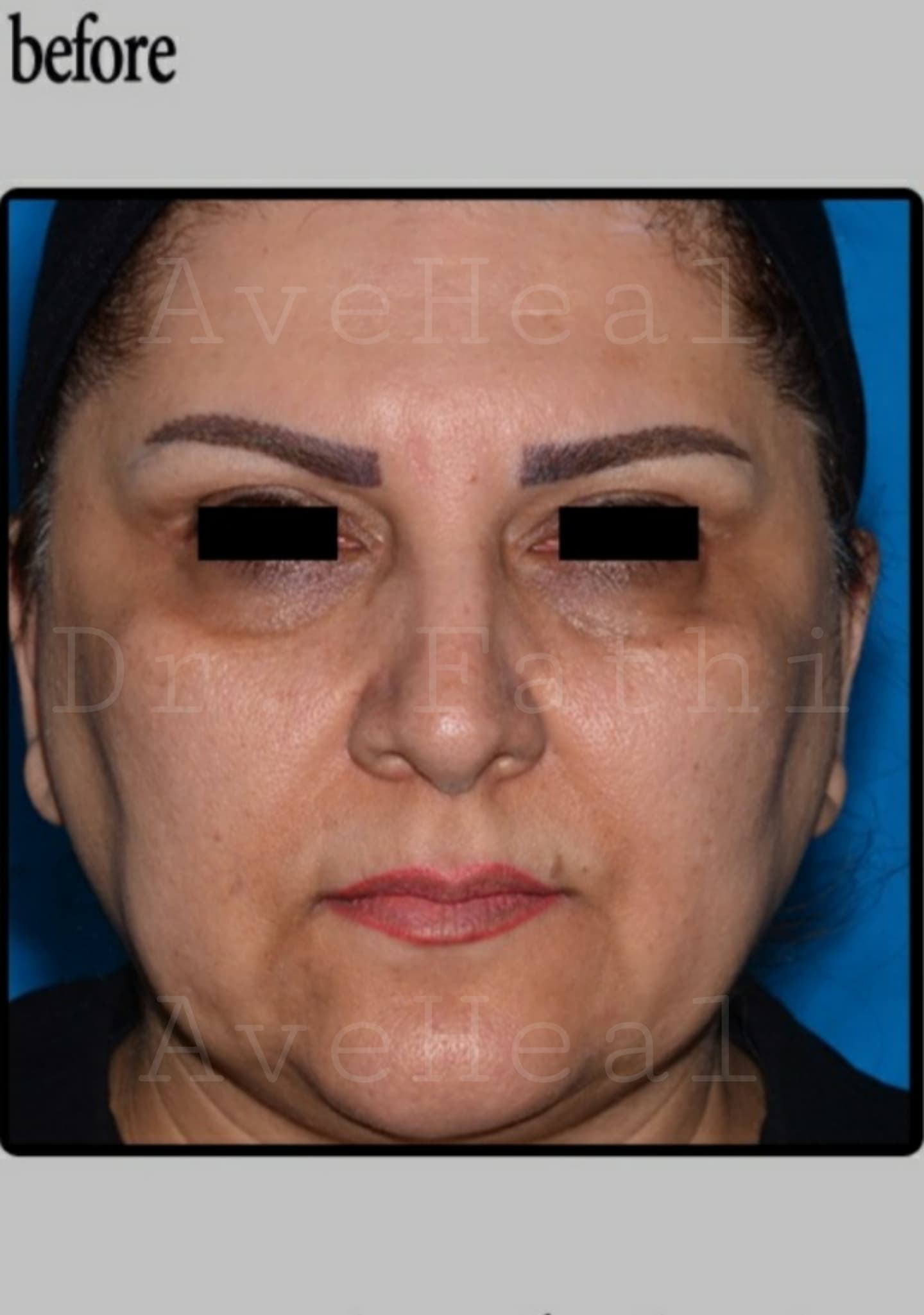 before-face-lift-dr-hamidreza-fathi