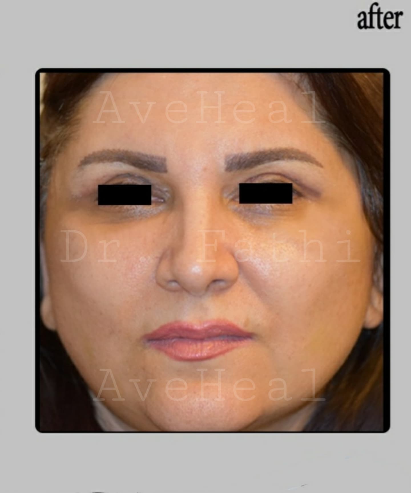 after-face-lift-dr-hamidreza-fathi