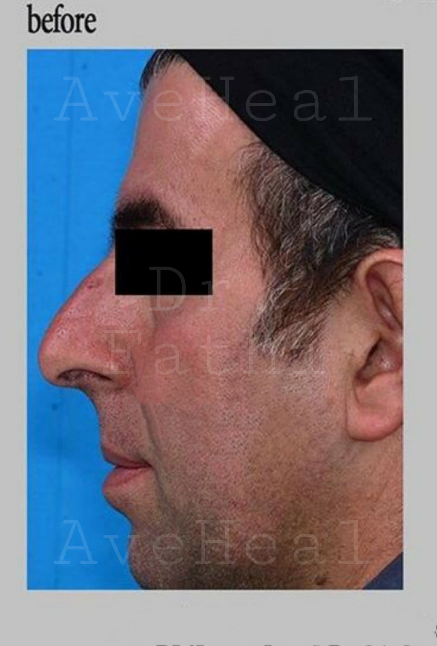 before-rhinoplasty-dr-hamidreza-fathi