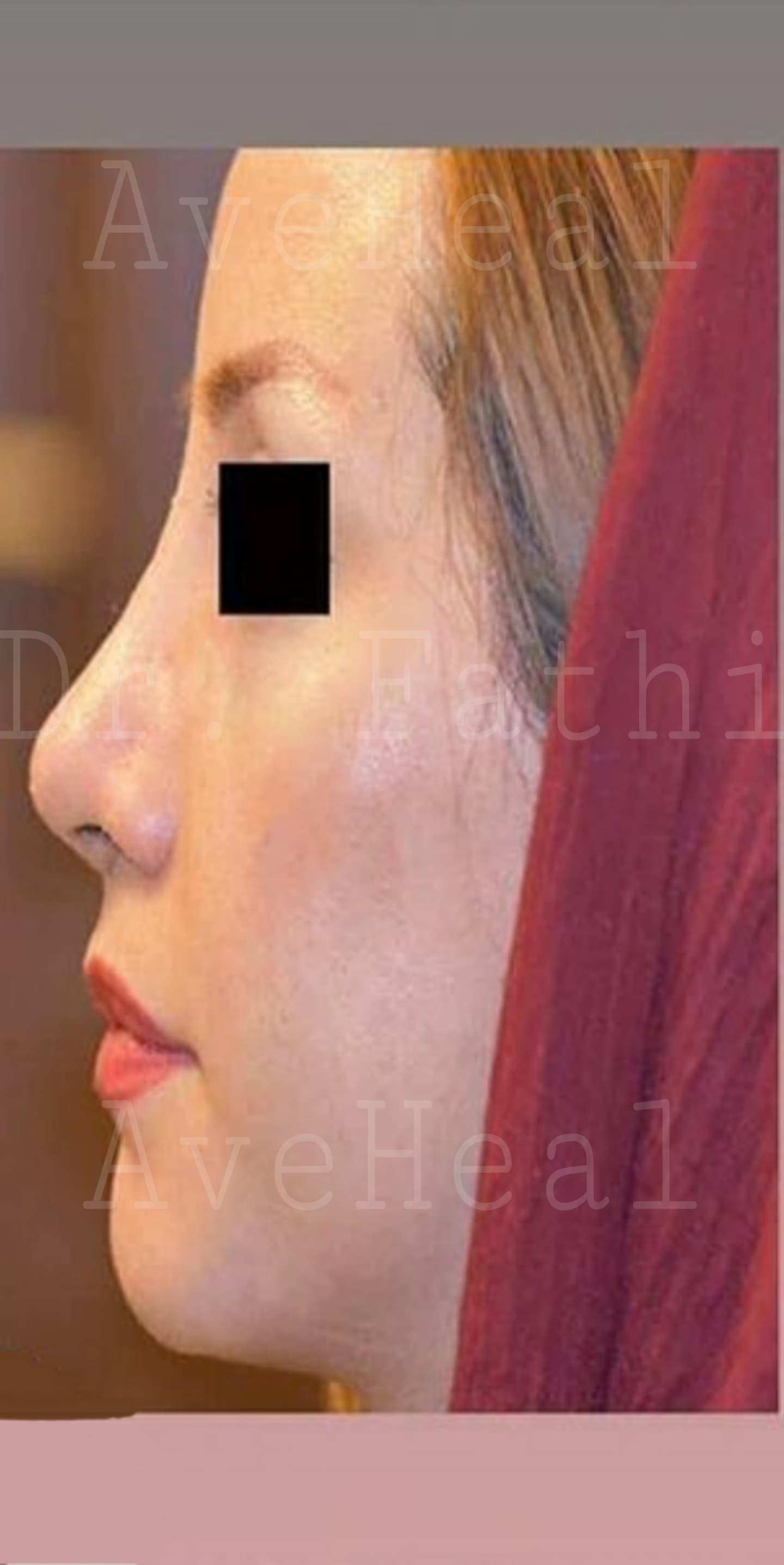 after-rhinoplasty-dr-hamidreza-fathi
