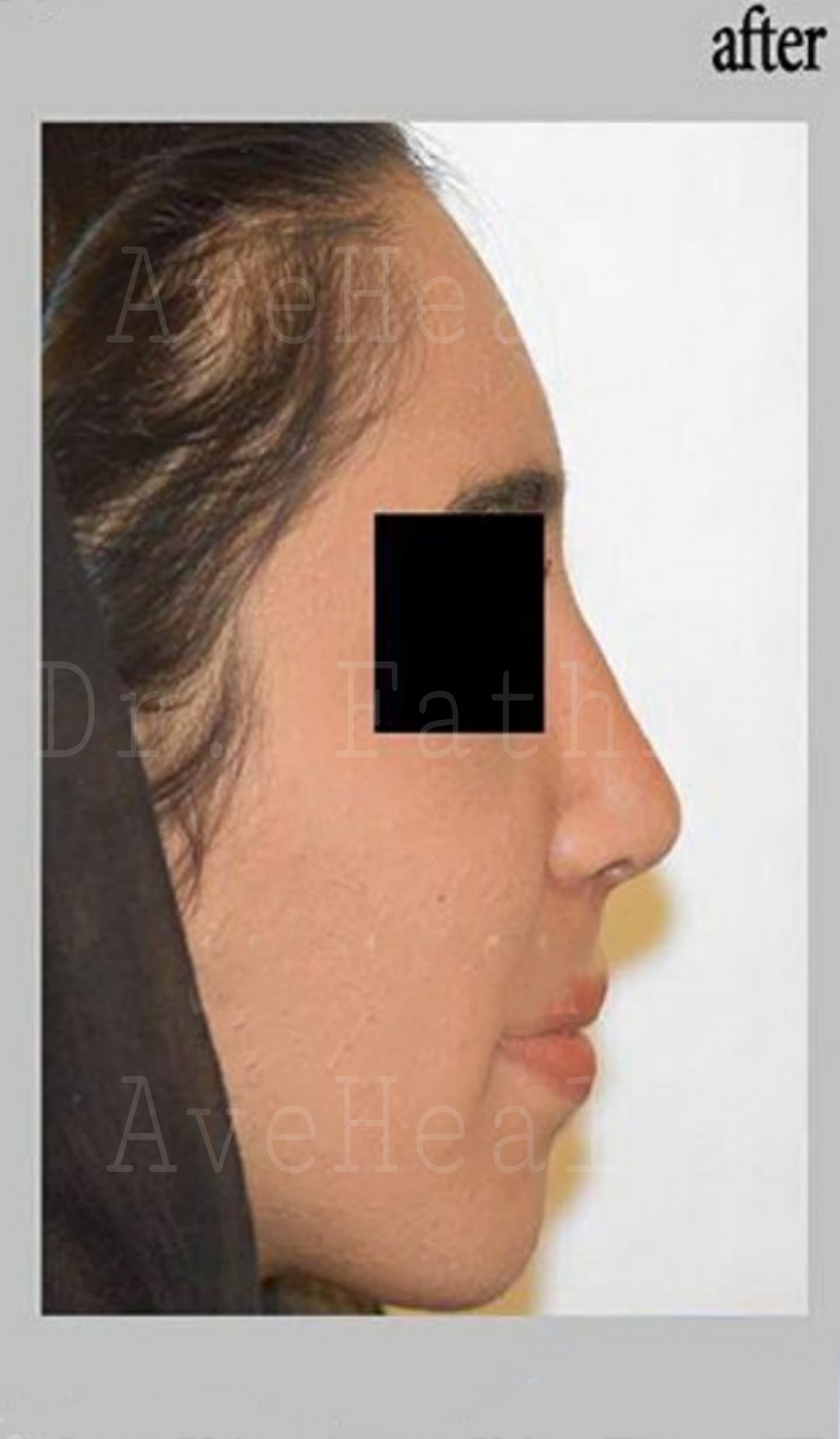 after-rhinoplasty-dr-hamidreza-fathi