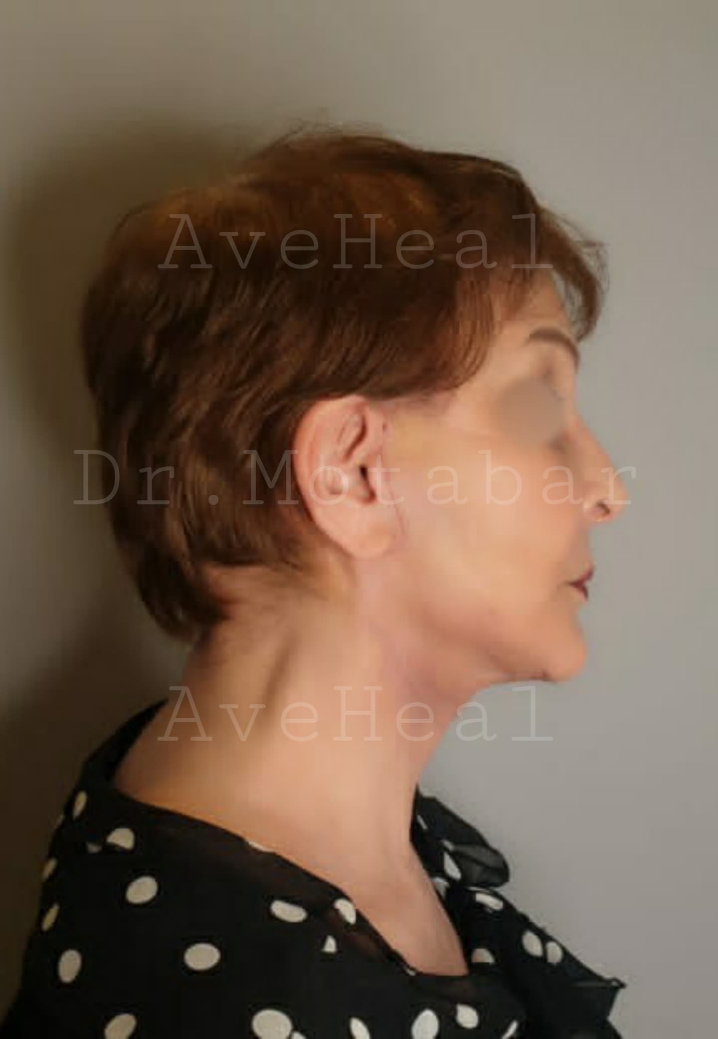 after-face-lift-dr-amirreza-motabar