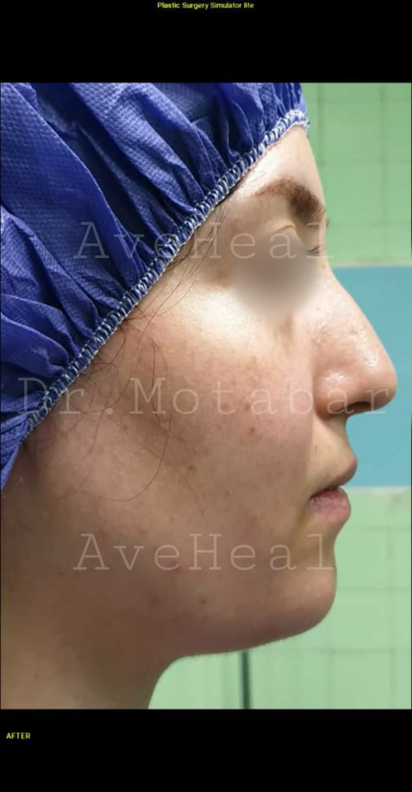 before-rhinoplasty-dr-amirreza-motabar