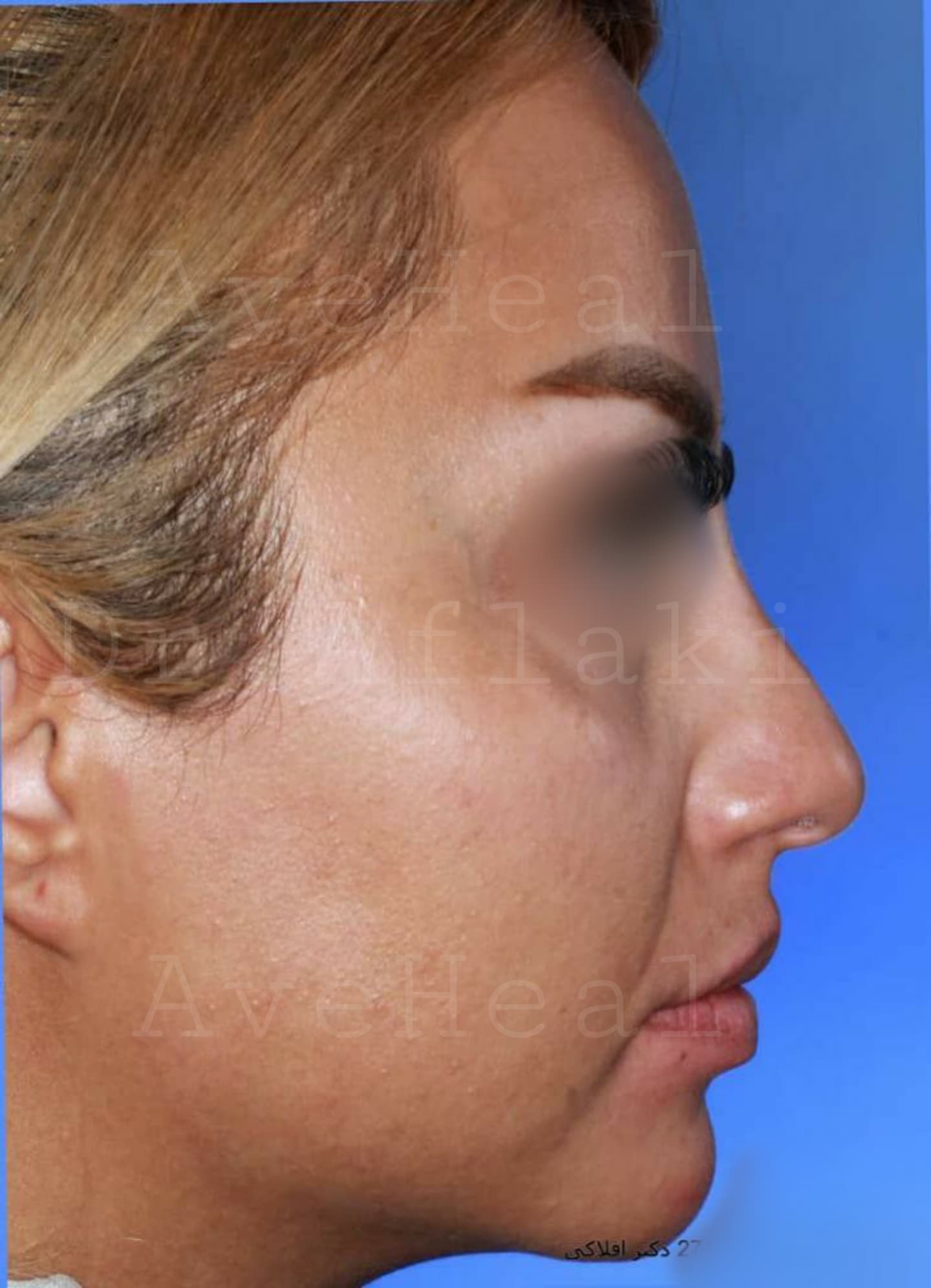 before-rhinoplasty-dr-pouria-aflaki