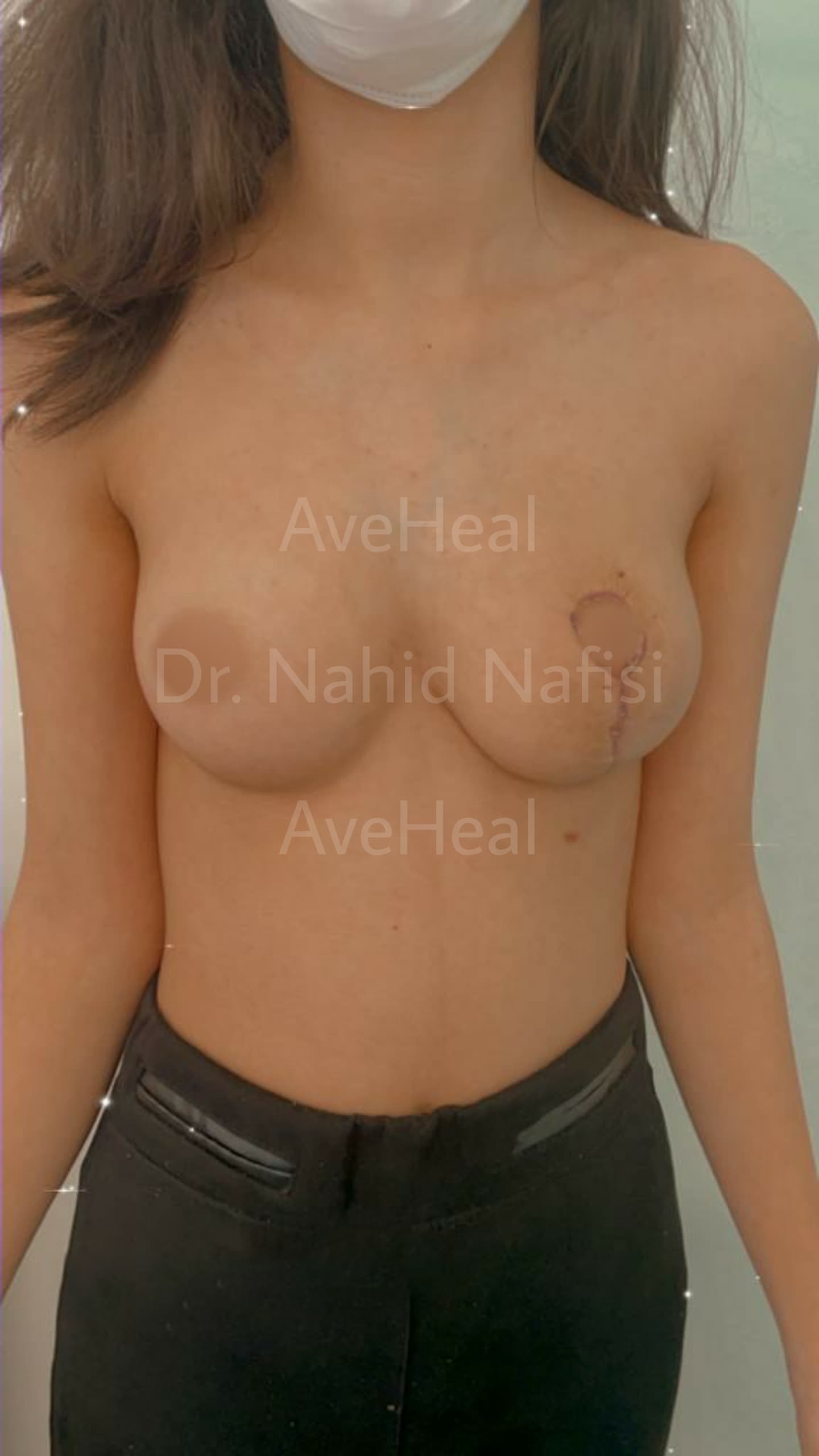 after-breast-reduction-dr-nahid-nafisi