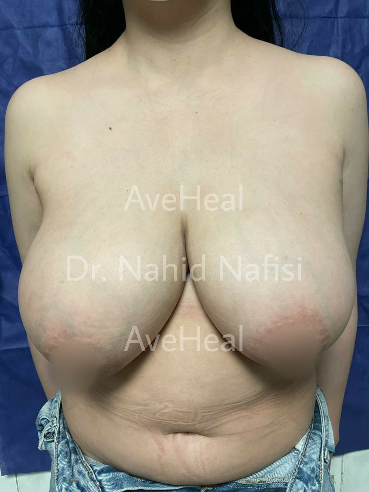 before-breast-reduction-dr-nahid-nafisi