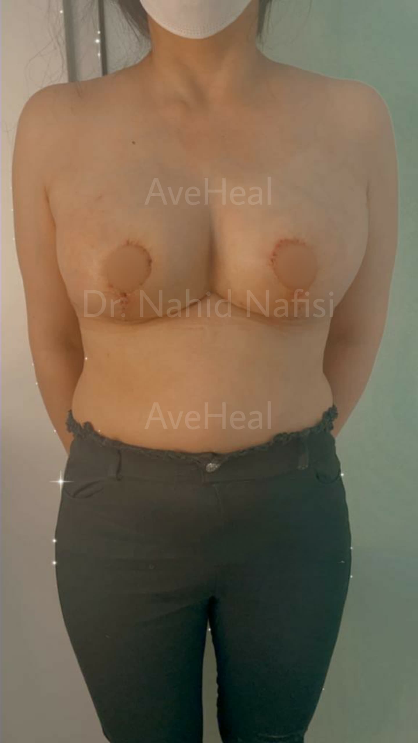 after-breast-reduction-dr-nahid-nafisi
