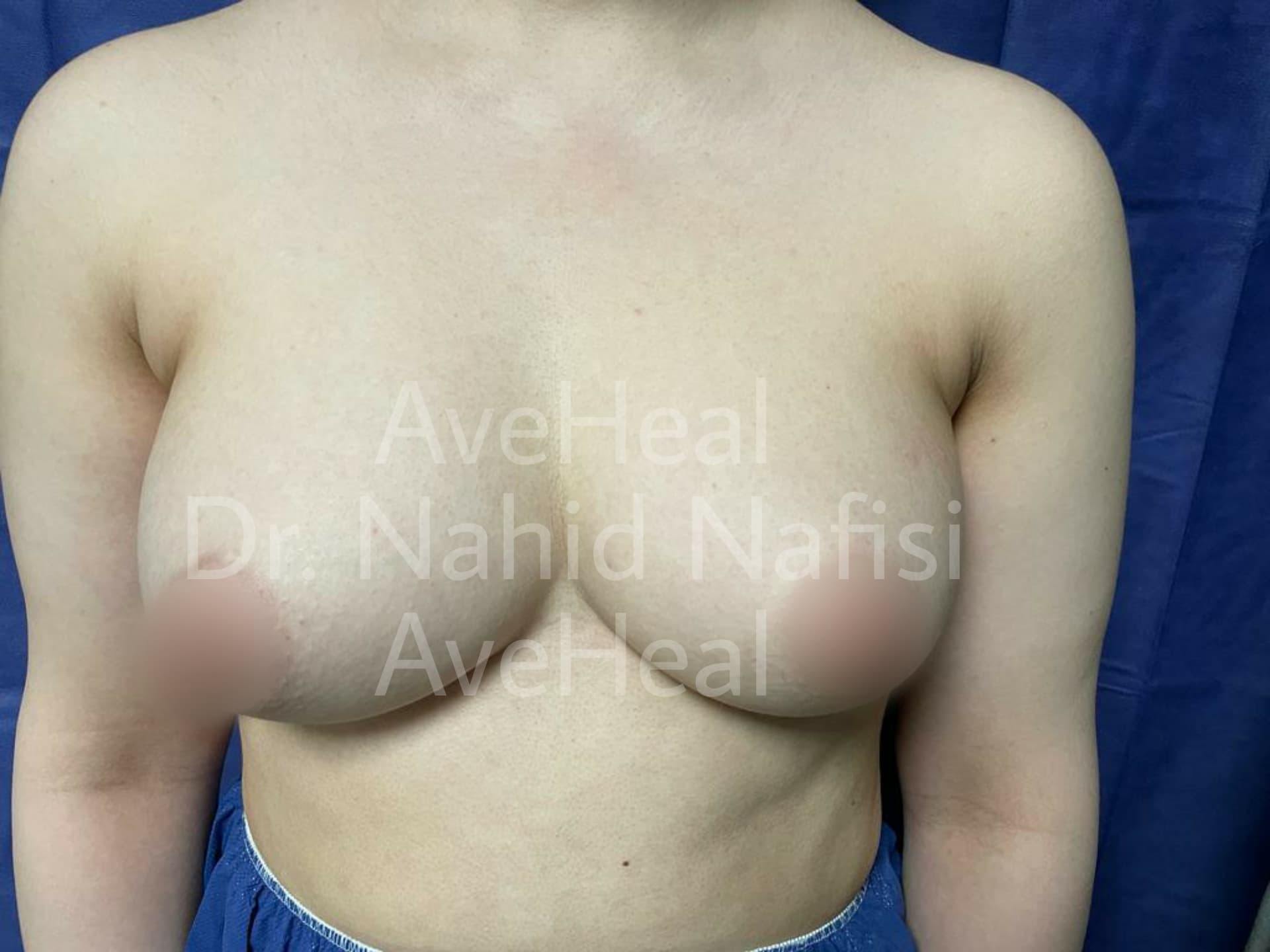 before-breast-augmentation-dr-nahid-nafisi
