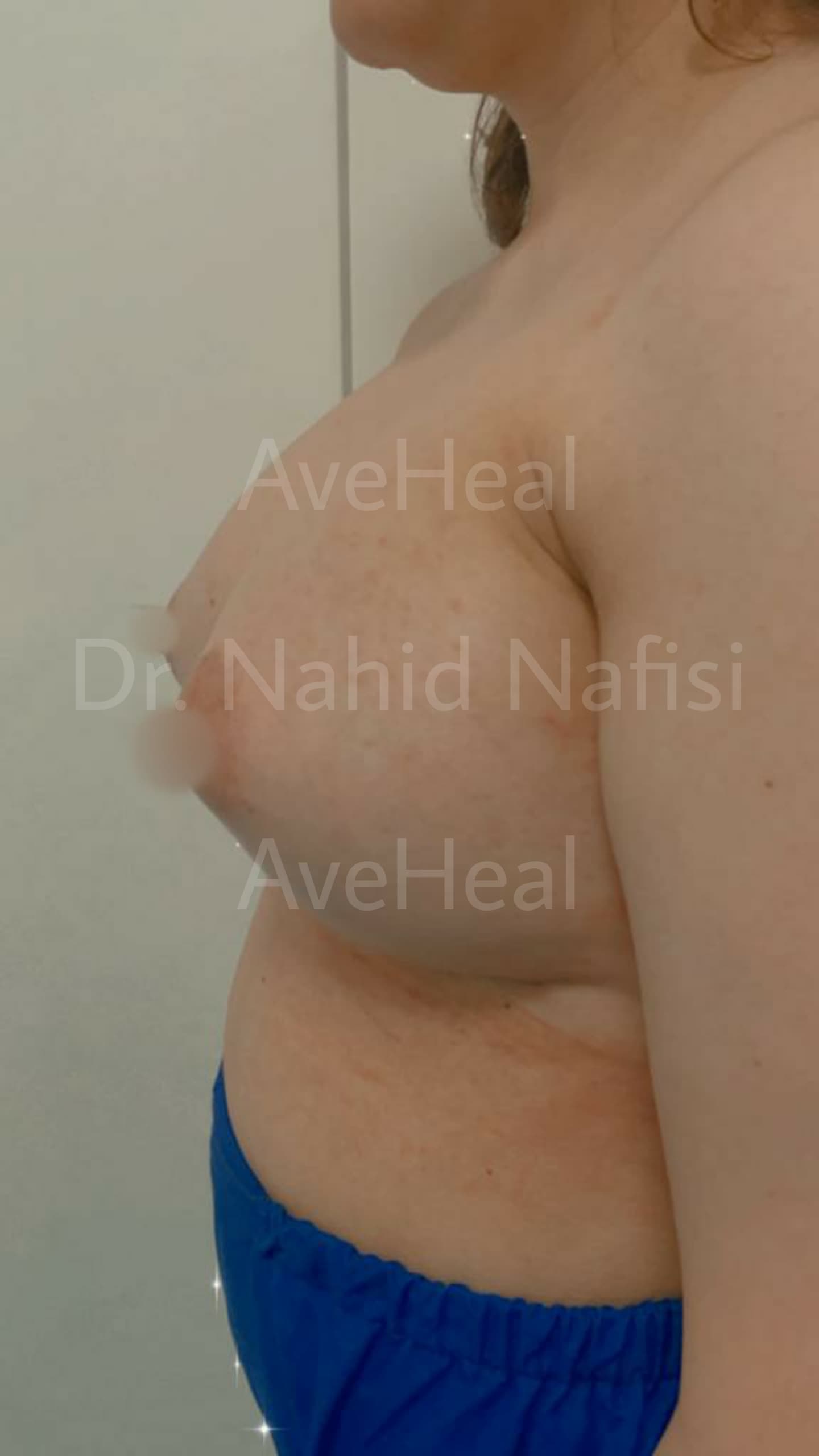 after-breast-augmentation-dr-nahid-nafisi