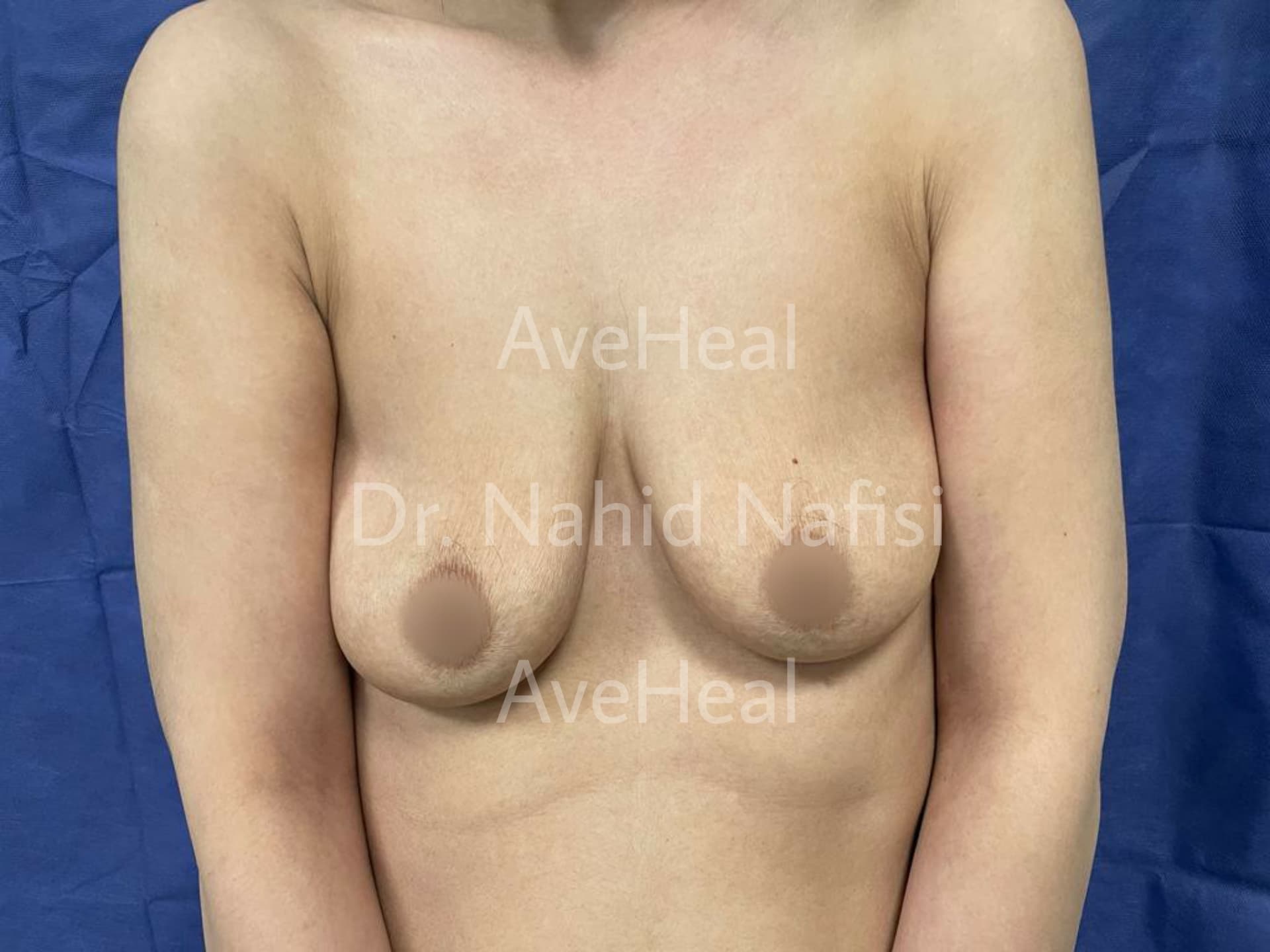 before-breast-augmentation-dr-nahid-nafisi