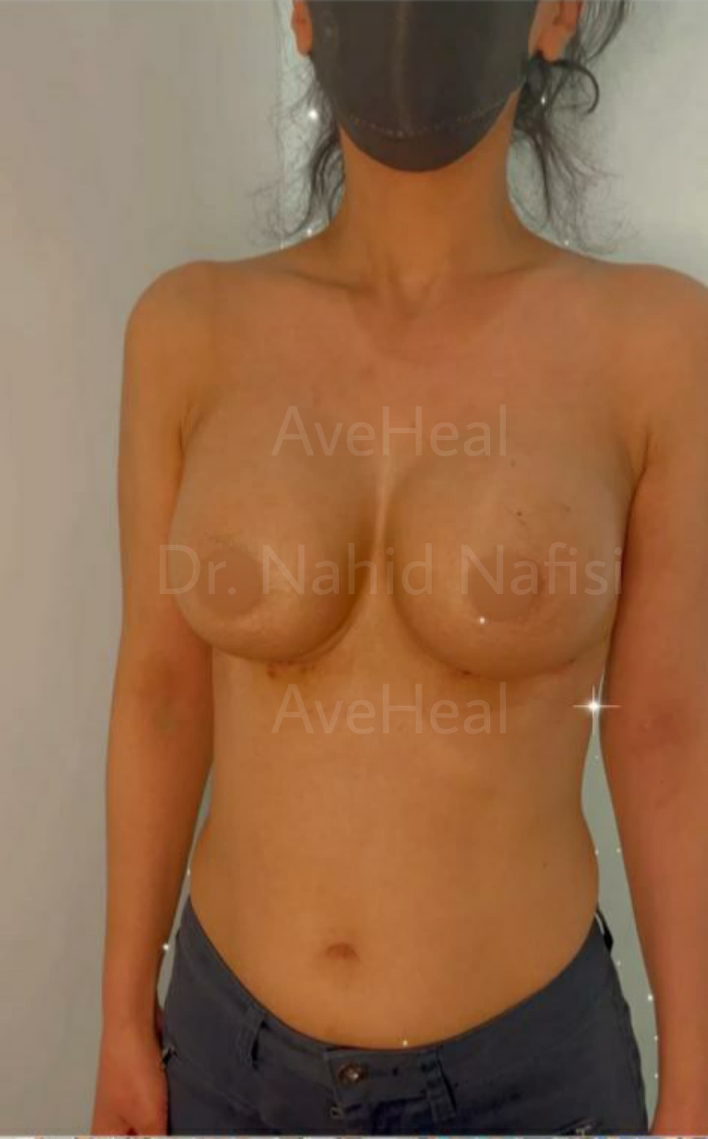 after-breast-augmentation-dr-nahid-nafisi