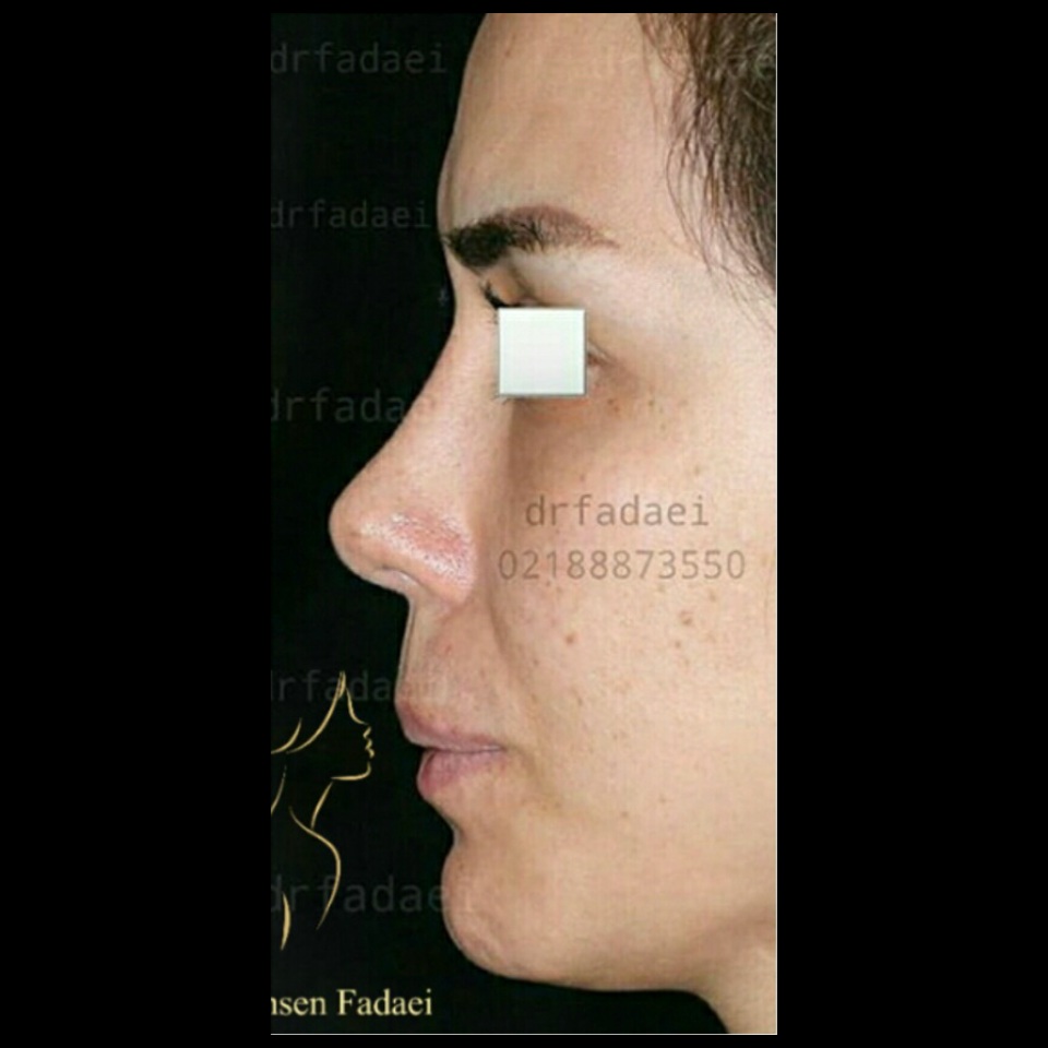 after-chin-implant-rhinoplasty-dr-mohsen-fadaei-iran