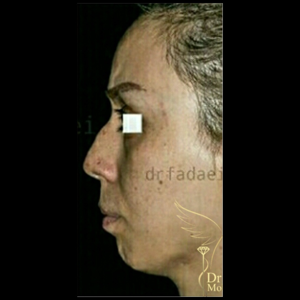 before-chin-implant-rhinoplasty-dr-mohsen-fadaei-iran