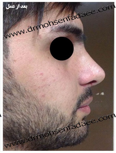 after-rhinoplasty-dr-mohsen-fadaei-iran