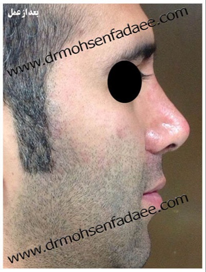 after-rhinoplasty-dr-mohsen-fadaei-iran
