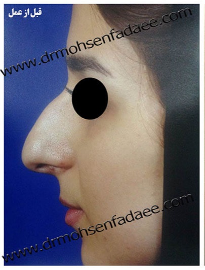 before-rhinoplasty-dr-mohsen-fadaei-iran
