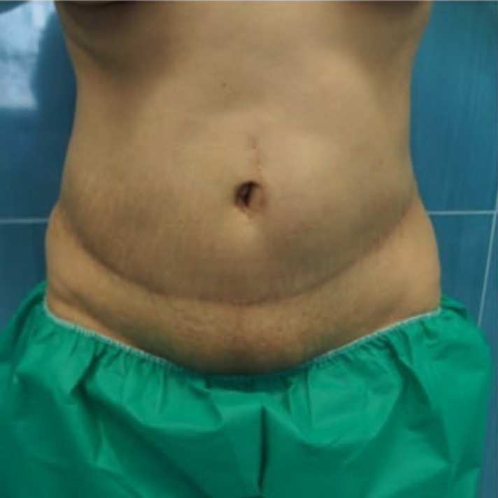 before-abdominoplasty-dr-majid-nadaf-kermani