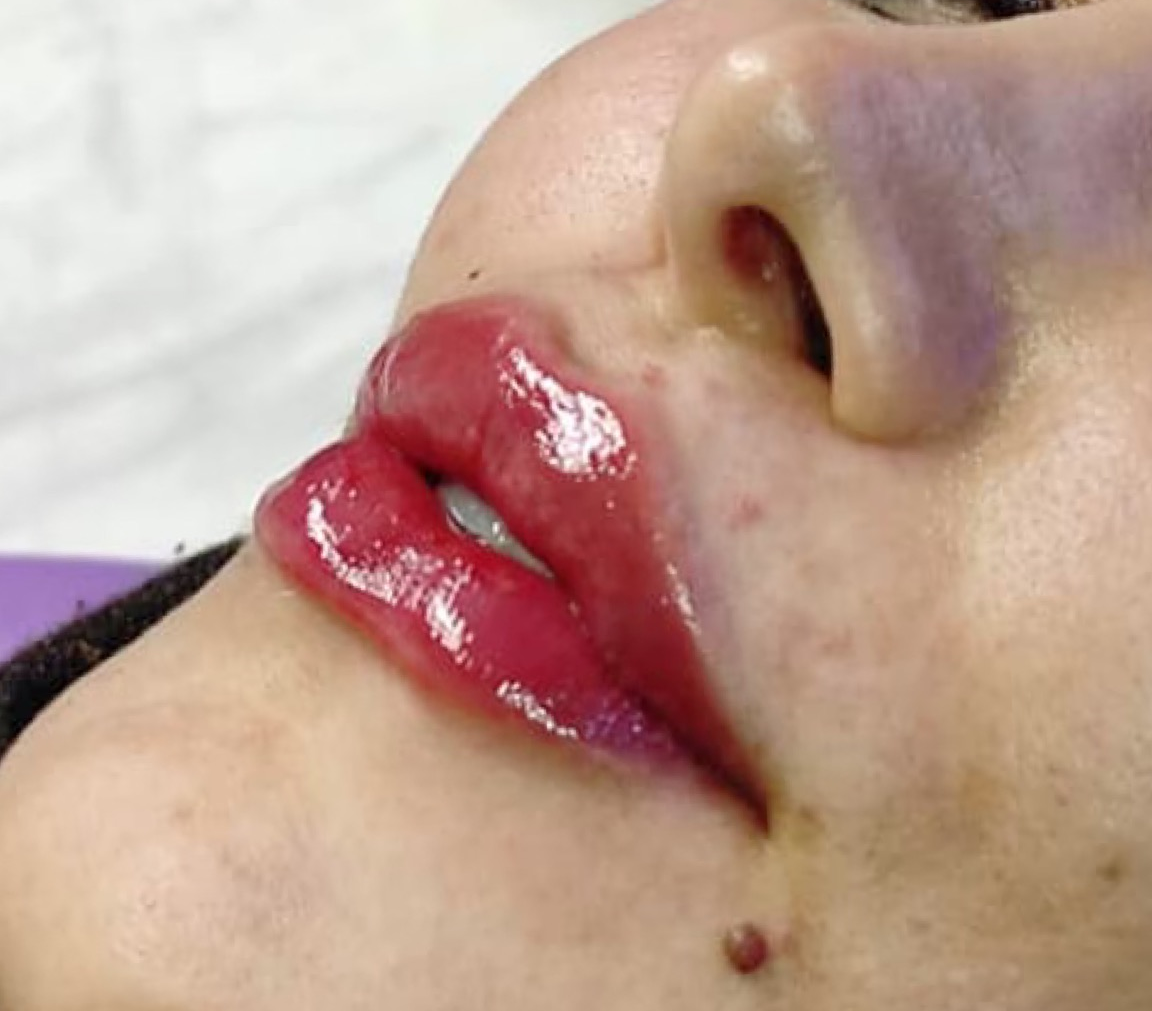 after-lip-augmentation-dr-daryani