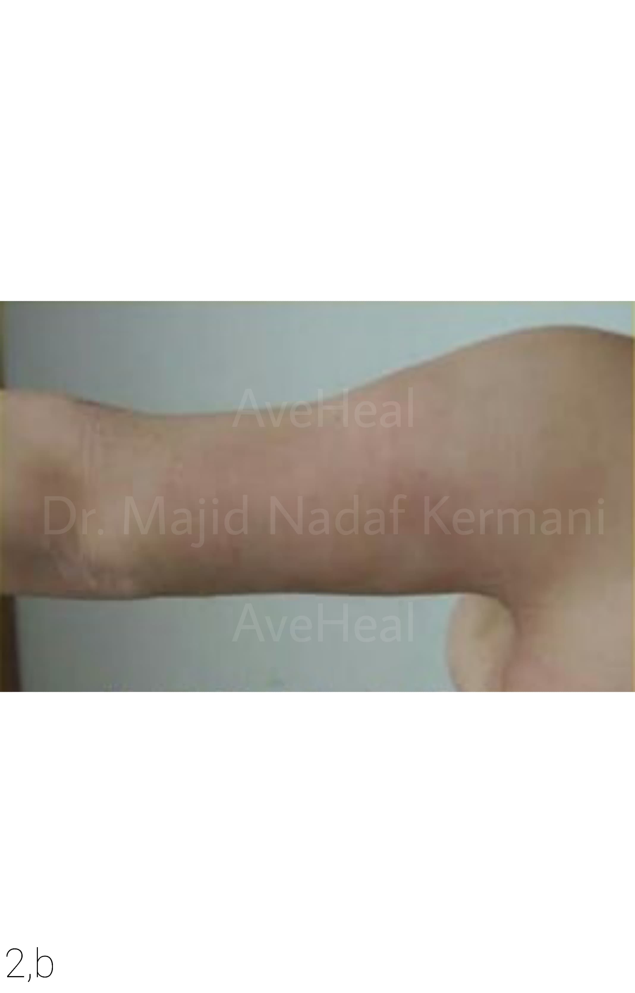 after-arm-lift-dr-majid-nadaf-kermani