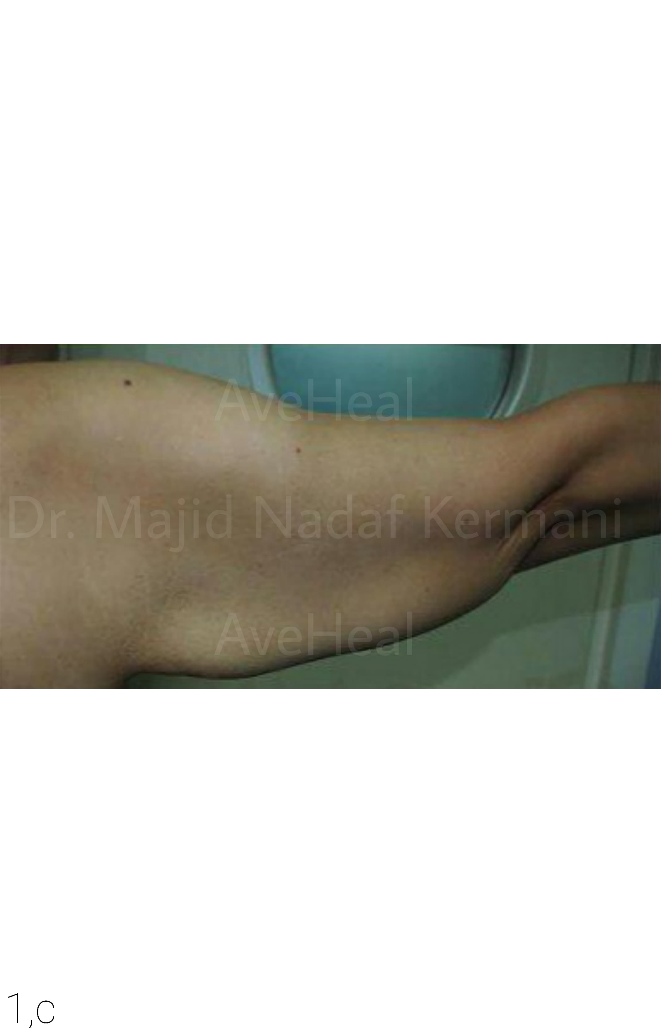 before-arm-lift-dr-majid-nadaf-kermani