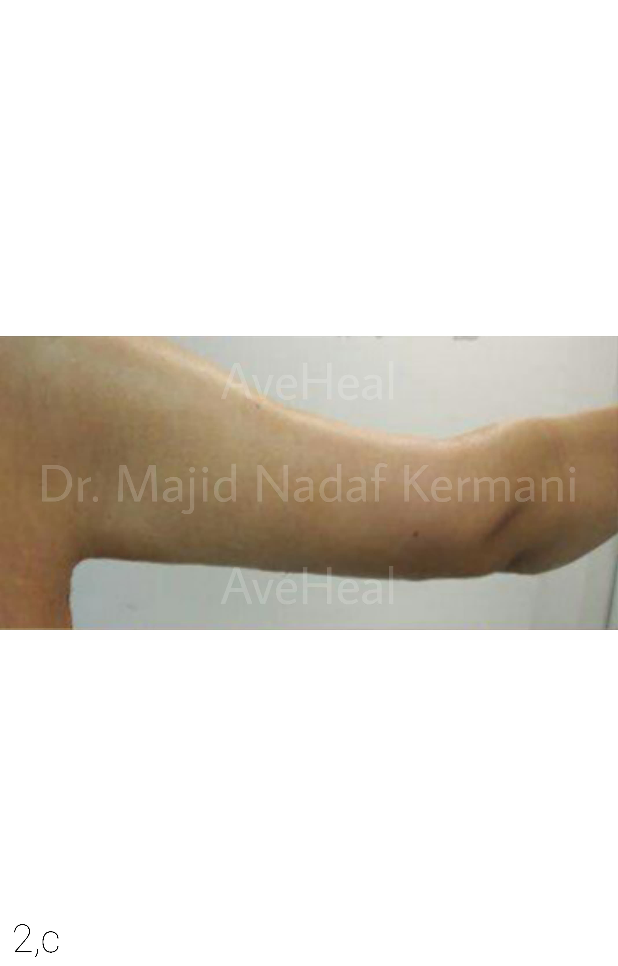 after-arm-lift-dr-majid-nadaf-kermani