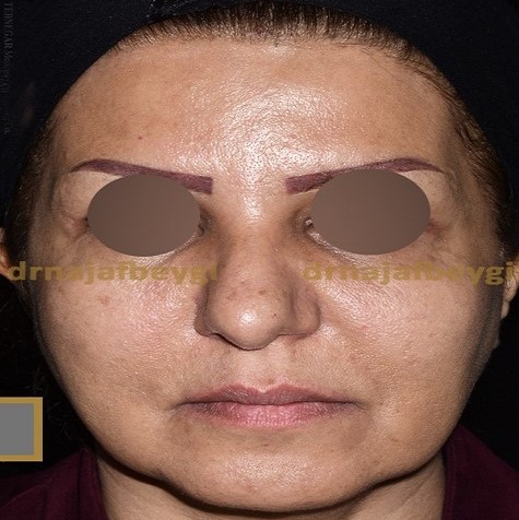 before-face-lift-dr-arash-najaf-beygi