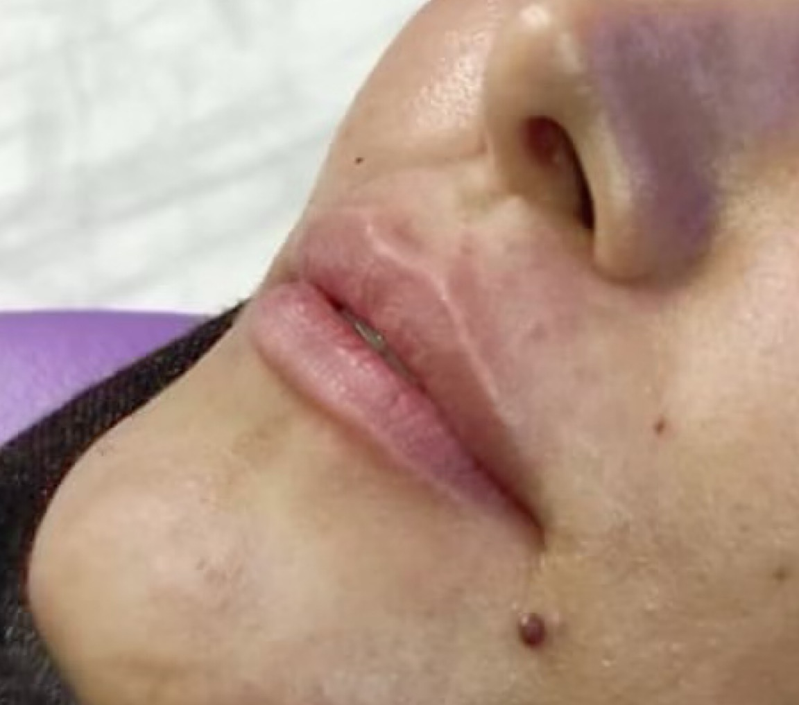 before-lip-augmentation-dr-daryani