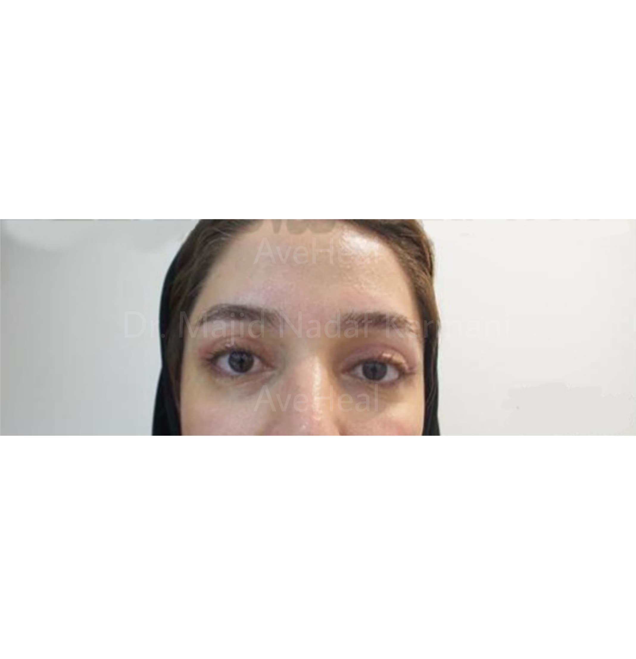 after-blepharoplasty-dr-majid-nadaf-kermani