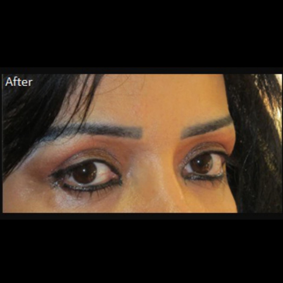 after-blepharoplasty-dr-shahriyar-yahyavi