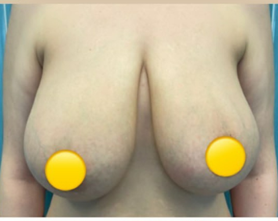 before-breast-reduction-dr-majid-nadaf-kermani