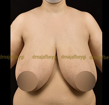 before-breast-lift-and-reduction-dr-arash-najaf-beygi