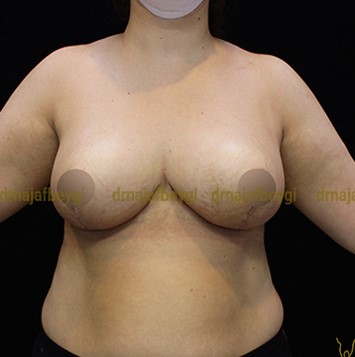 after-breast-lift-and-reduction-dr-arash-najaf-beygi