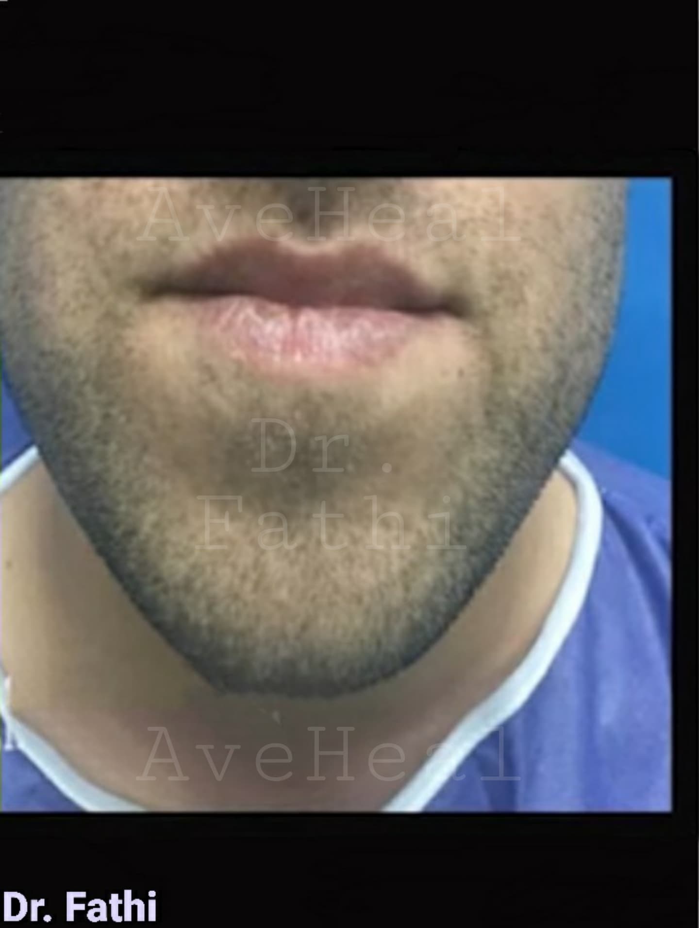 before-chin-reduction-dr-hamidreza-fathi