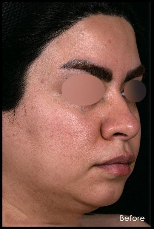 before-chin-implant-dr-shahriyar-yahyavi