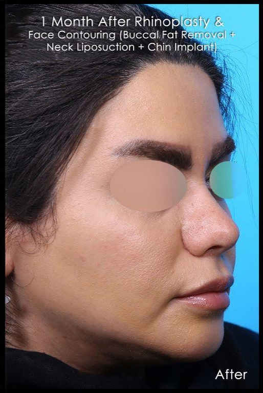 after-chin-implant-dr-shahriyar-yahyavi