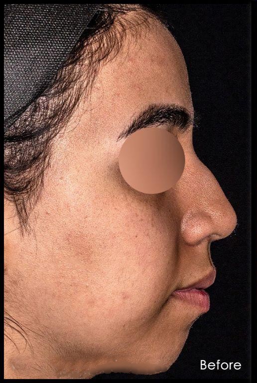 before-chin-implant-dr-shahriyar-yahyavi