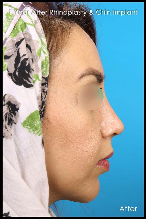 after-chin-implant-dr-shahriyar-yahyavi