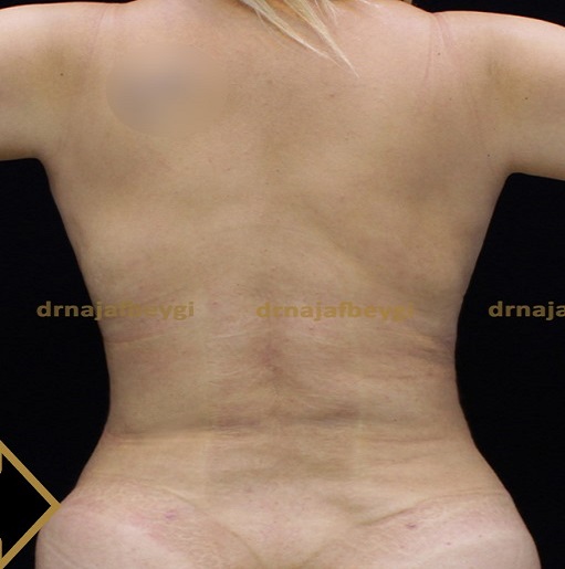 after-liposuction-dr-arash-najaf-beygi