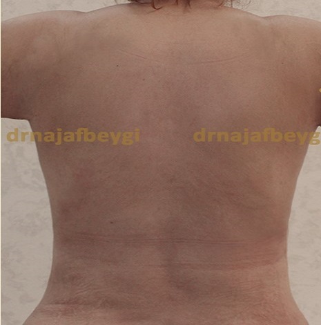 after-liposuction-dr-arash-najaf-beygi