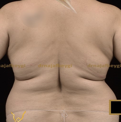 before-liposuction-dr-arash-najaf-beygi