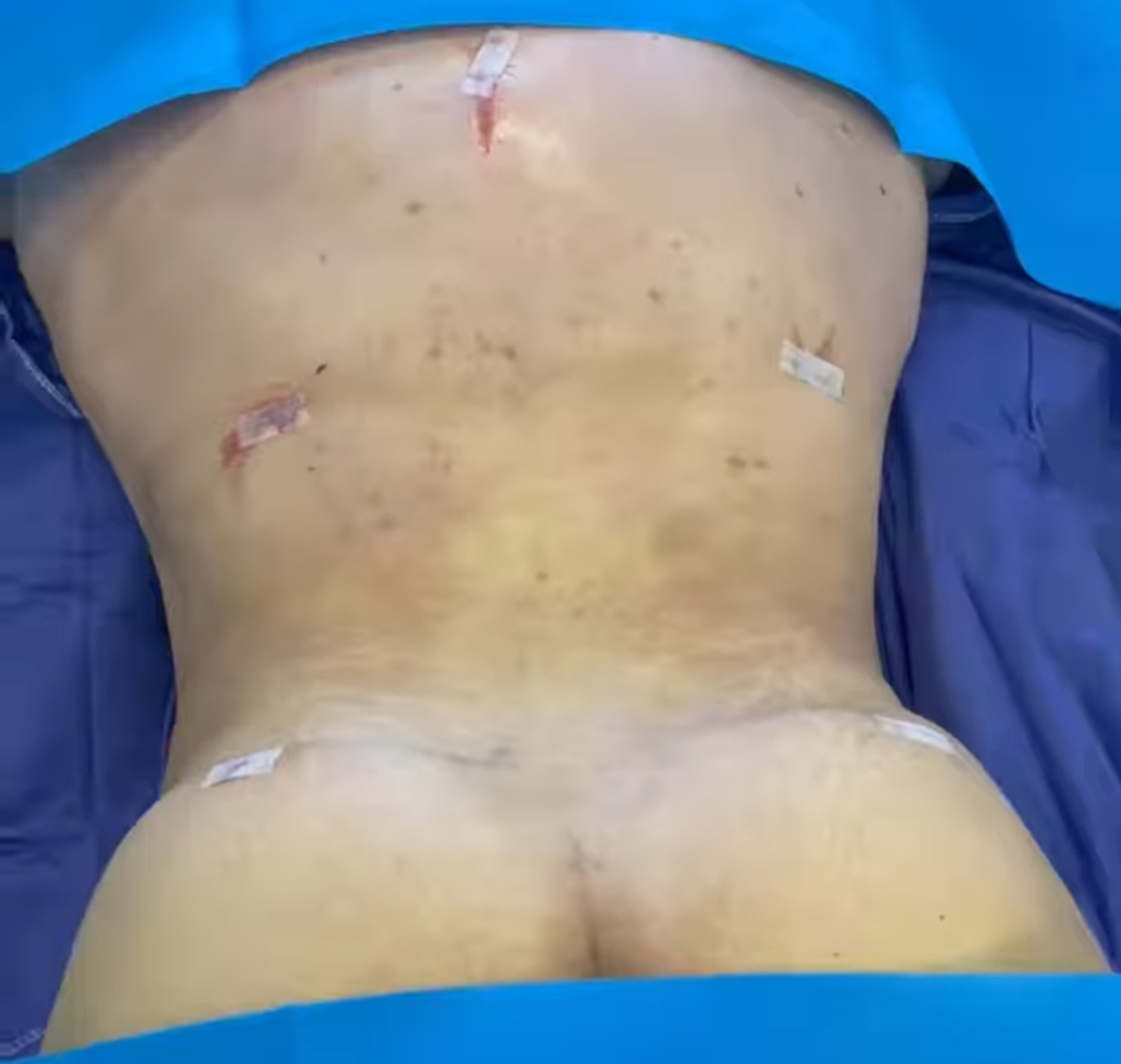 after-liposuction-dr-majid-nadaf-kermani