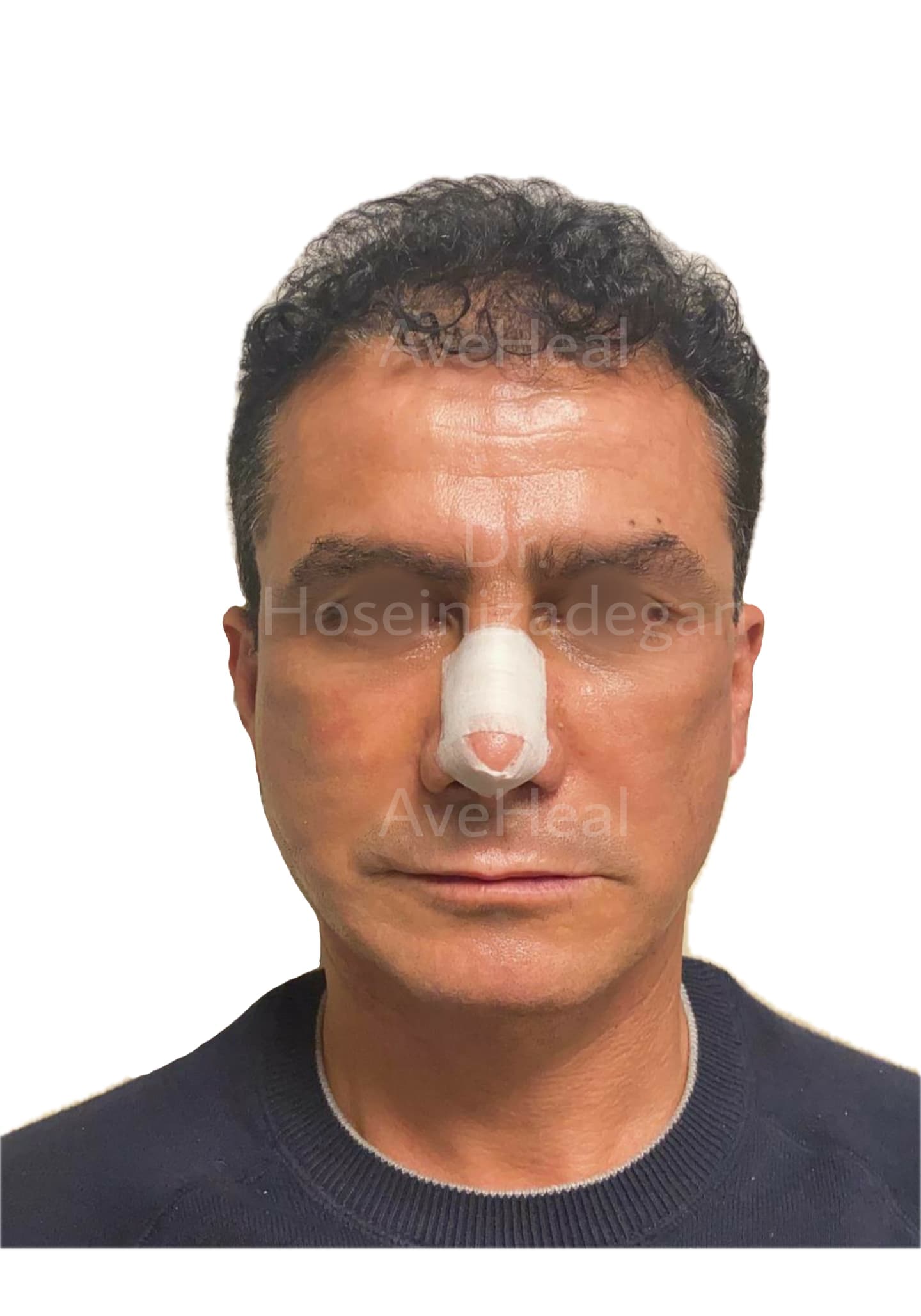 after-face-lift-and-rhinoplasty-dr-fatemeh-hoseini-zadegan-shirazi