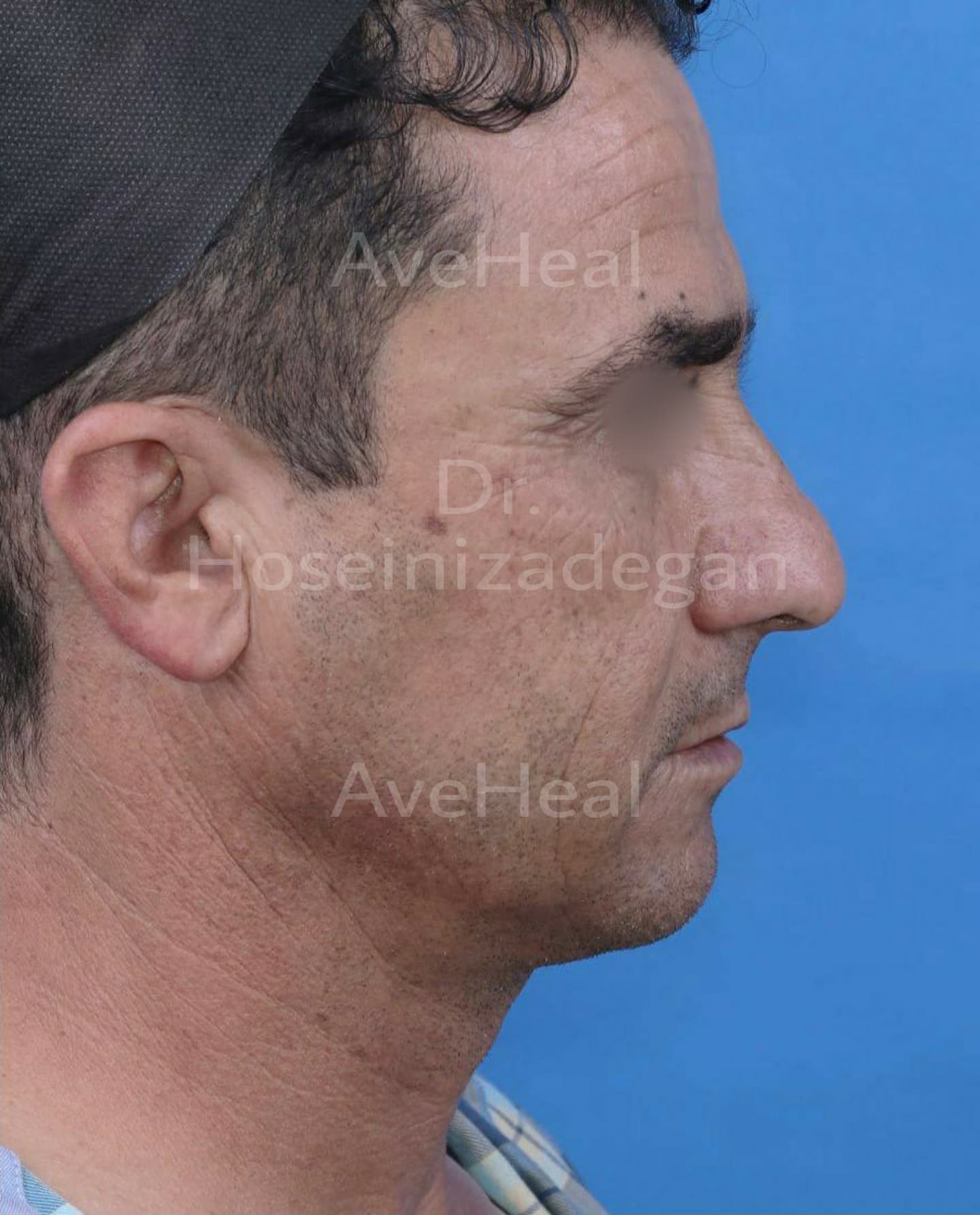 before-face-lift-and-rhinoplasty-dr-fatemeh-hoseini-zadegan-shirazi